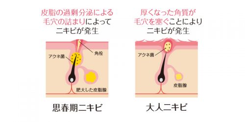思春期ニキビと大人ニキビのでき方の違い