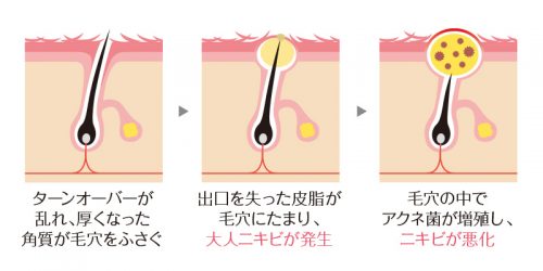 大人ニキビの原因となる角質肥厚